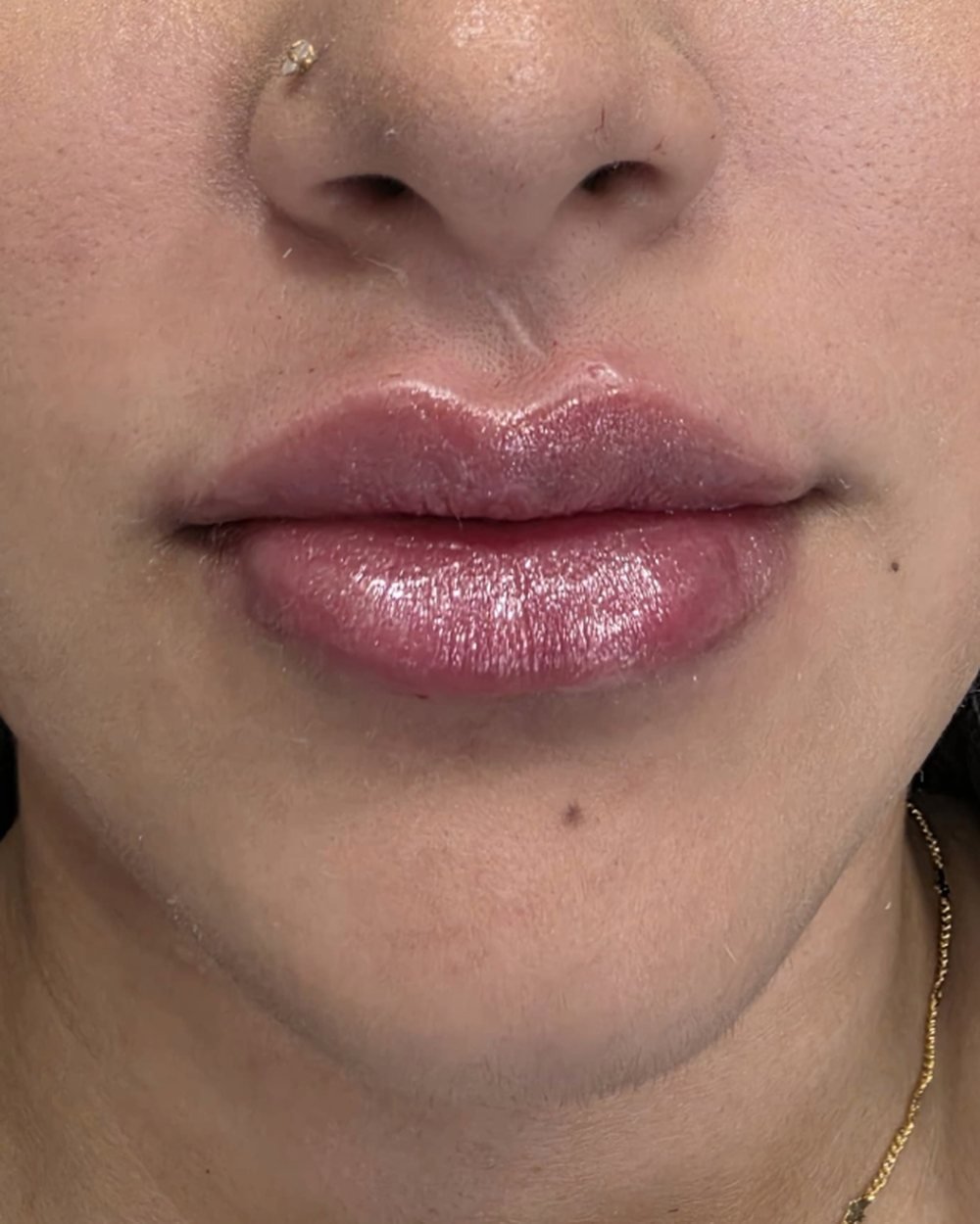 Antes - Preenchimento Labial