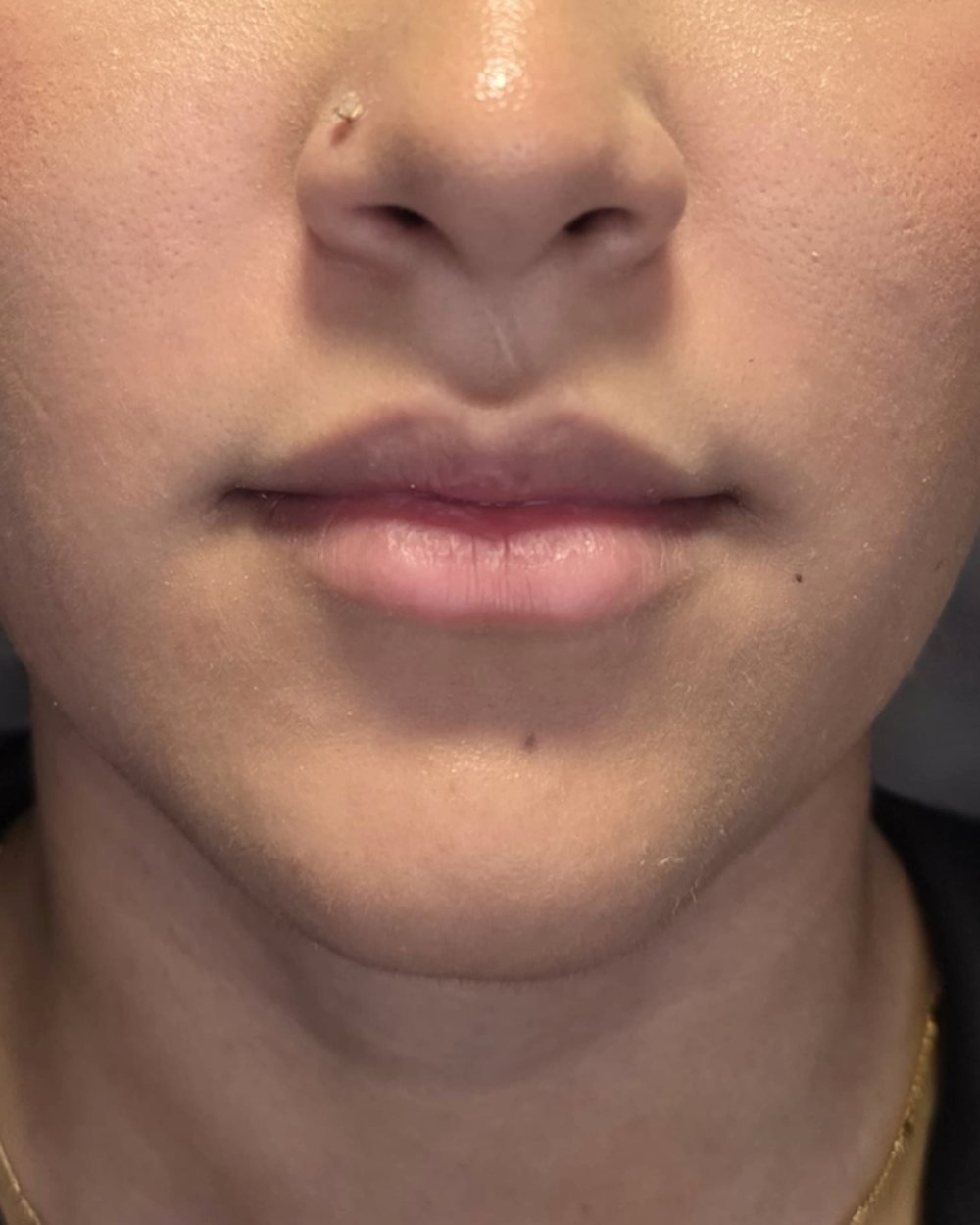 Depois - Preenchimento Labial