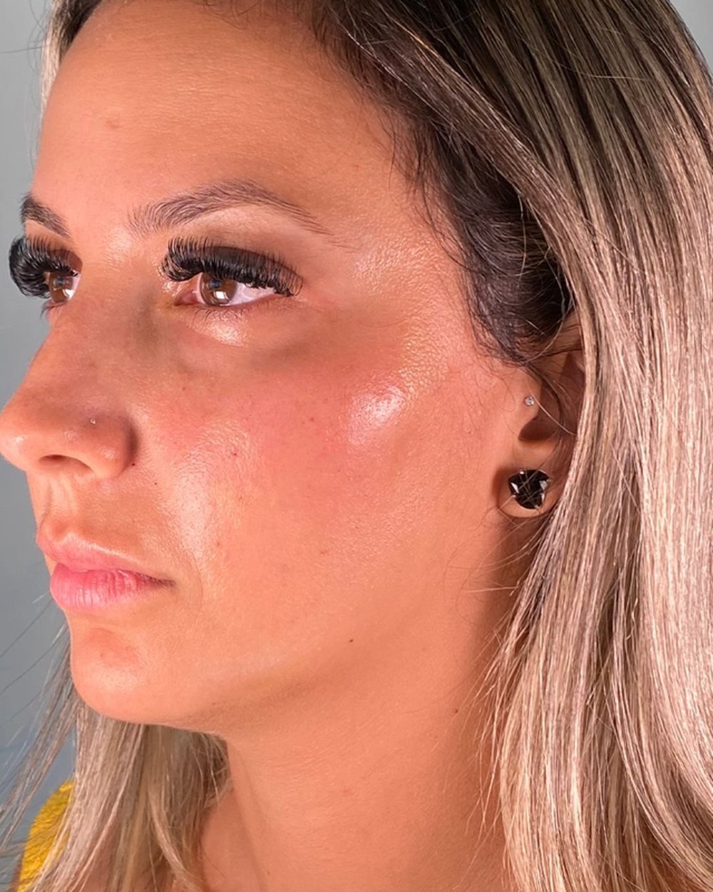 Antes - Preenchimento Malar