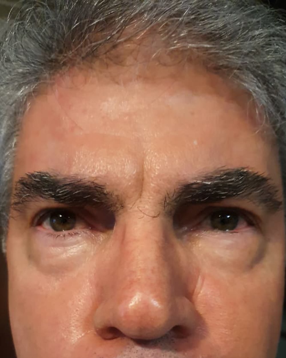 Antes - Rejuvenescimento