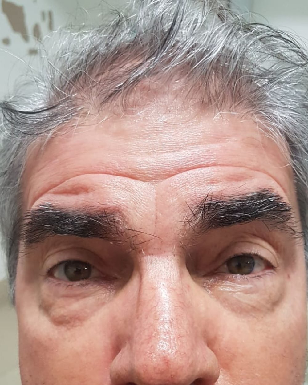 Depois - Rejuvenescimento